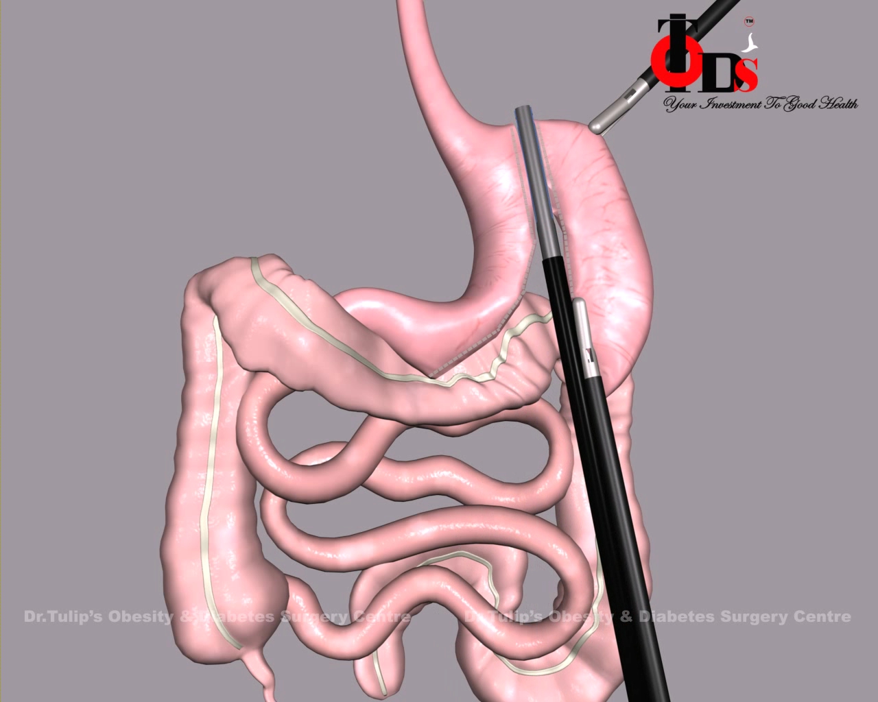  Sleeve Gastrectomy im2